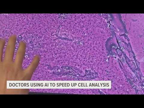 AI technology helping doctors diagnose and treat cancer faster
