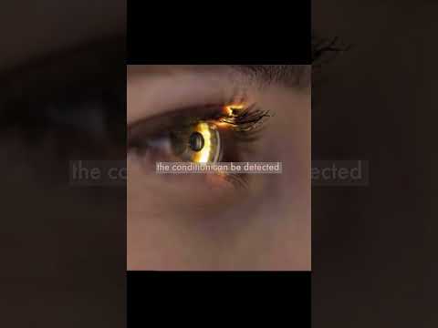 Revolutionary Use of AI to detect early Parkinson disease from eye scan #healthcare #scan#parkinson